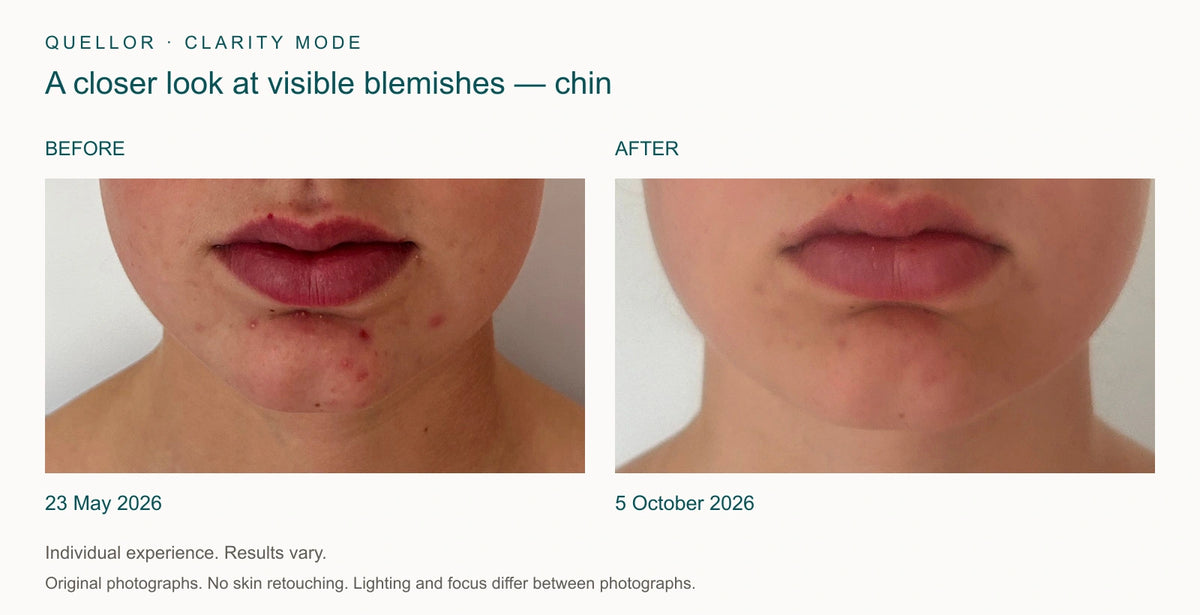 Chin detail before and after Clarity Mode, 23 May and 5 October 2026.