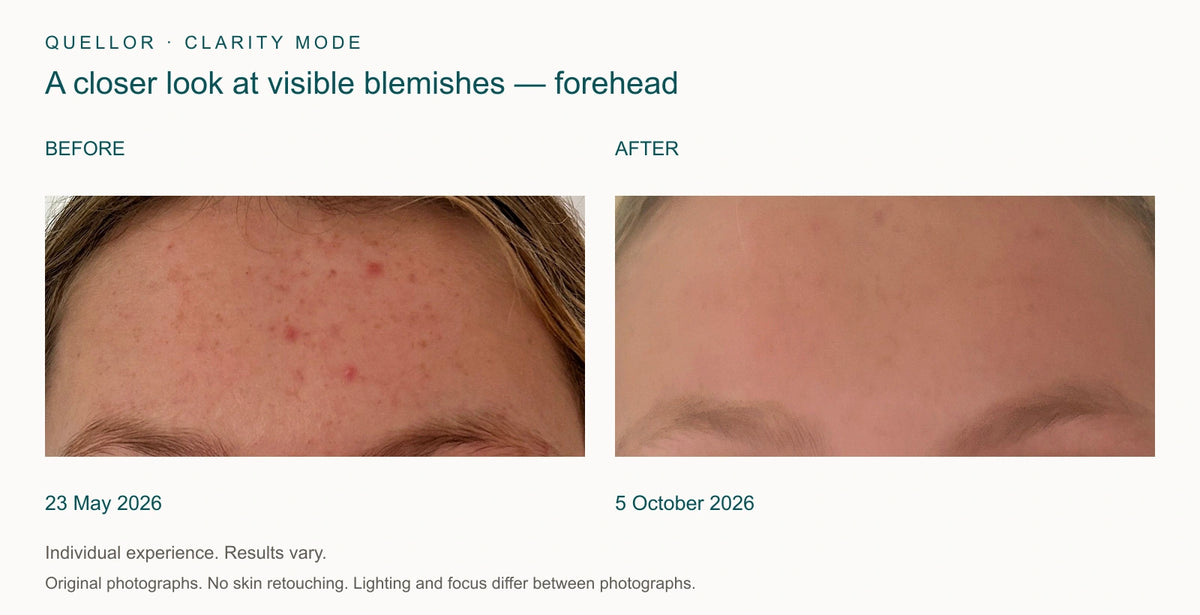 Forehead detail before and after Clarity Mode, 23 May and 5 October 2026.