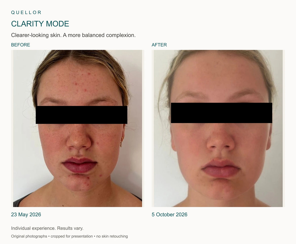 Clarity Mode before and after, 23 May and 5 October 2026. Eyes covered for privacy.